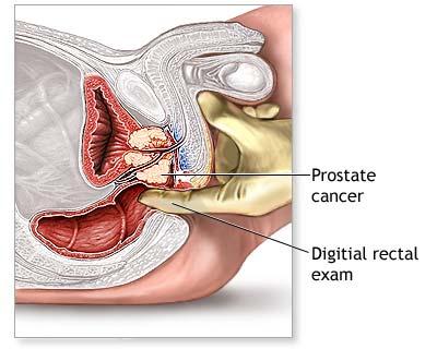 Abces prostatic