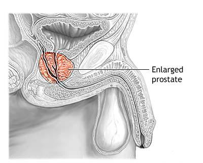 gingembre et prostate prostatita este cauza bolii