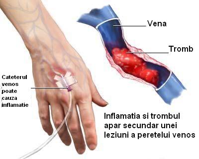 tratamentul cu varice de mâna de mâna durere varicoasa în umflarea picioarelor