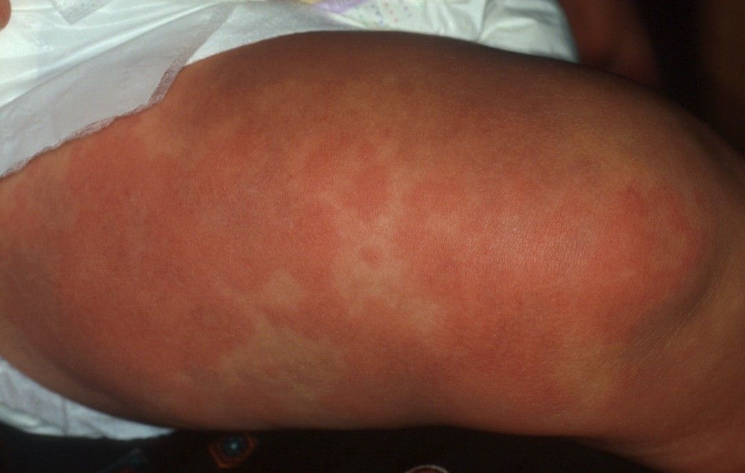 Alergiile copiilor nostri - Cauze, simptome, tratament si profilaxie