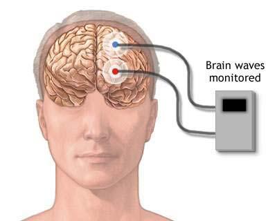 Electroencefalograma (EEG) - utila in diagnosticul epilepsiei
