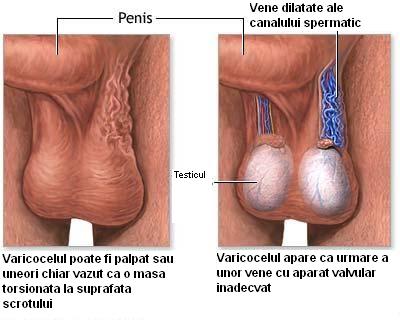 Varicocelul - dilatatia venelor spermatice