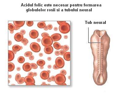 Defect de tub neural - favorizat de deficitul de acid folic