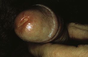 Gonoreea sau infectia gonococica