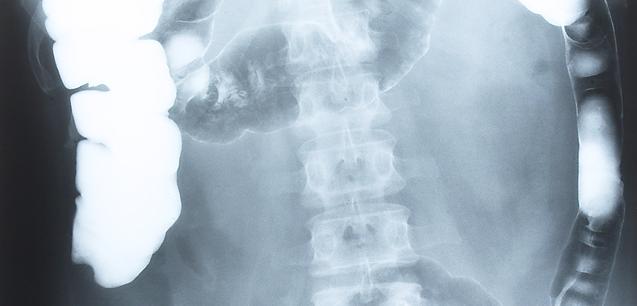 Cancer colorectal si anal