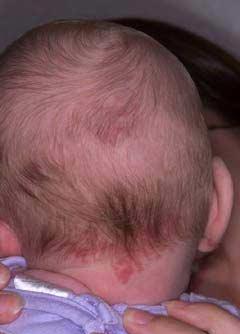 Pete  de culoarea somonului (numite si ciupituri de barza) 