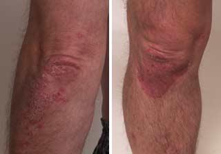 Psoriazis