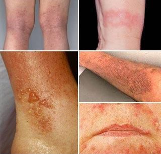 Mai multe tipuri de dermatita