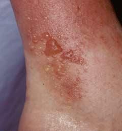 Dermatita alergica de contact
