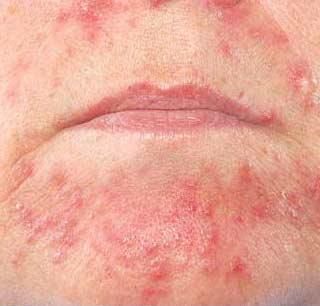 Dermatita periorala