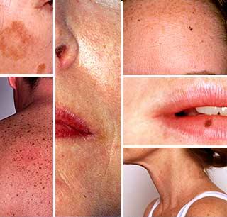 Leziunile solare apar in timp