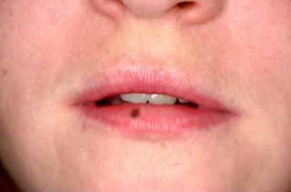 Lentigo labial