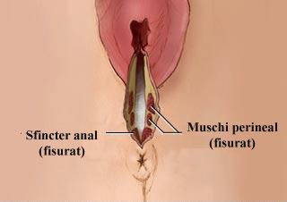 Rupturi de gradul trei
