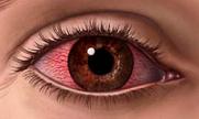Alte afectiuni inflamatorii oculare