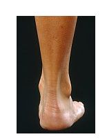 Care sunt cauzele durerii tendonului lui Ahile?