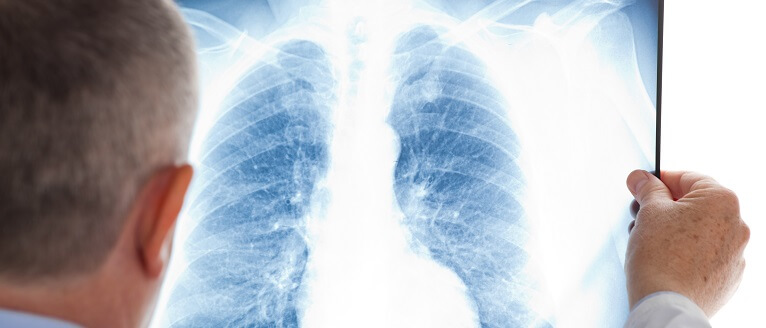 Curatarea plamanilor afectati de boala, fumat sau poluare