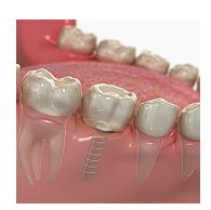 Implantologia-posibilitatea unei a III-a dentitii