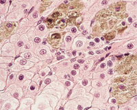 Infectii ce pot determina malformatii