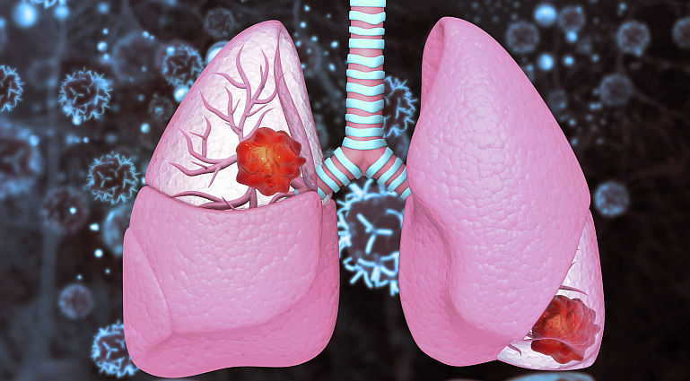 Cancerul pulmonar, ucigasul nr. 1