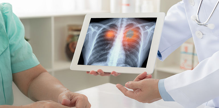 Cancerul pulmonar poate fi vindecat, daca il depistezi la timp