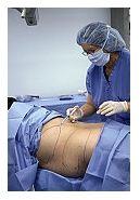 Chirurgia abdomenului cu pliuri (abdominoplastia)