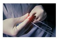 Colposcopia si biopsia cervicala - informatii generale
