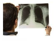 Bolile Pulmonare – subiect de dezbatere la Conferinta Nationala a Pacientilor, editia a II a