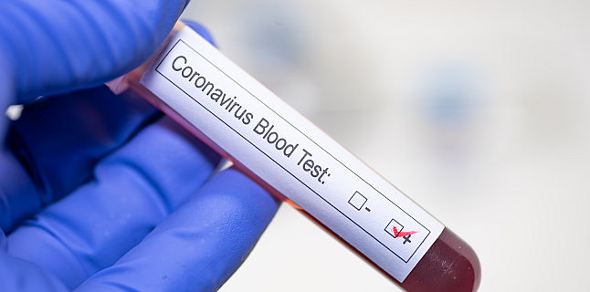 Au fost confirmate 139 de cazuri de persoane infectate cu virusul COVID – 19 (coronavirus)