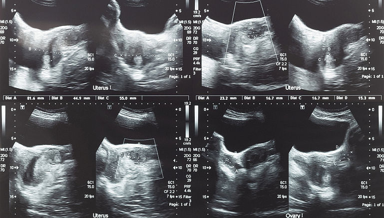 Fibromul uterin