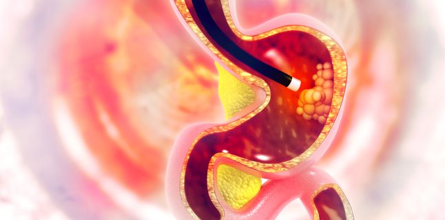 Factori ce predispun la cancer gastro-esofagian