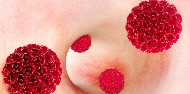 Papiloame în jurul anusului, Infecția HPV
