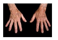 boli sistemice ale artritei reumatoide ale țesutului conjunctiv tratamentul articular în fraternitate