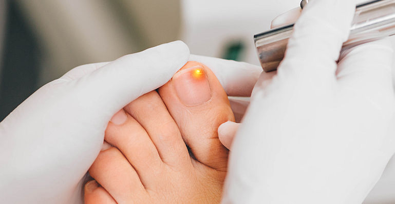 Cum se tratează ciuperca unghiilor cu laser, eficacitatea și contraindicațiile acesteia
