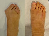 artrita reumatoidă a degetelor de la picioare dureri de spate la om