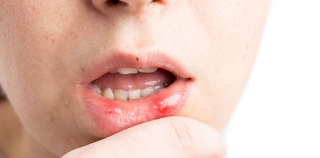 papilomatoza diagnosticului clinicii cavității bucale