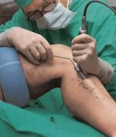 chirurgie cu laser varicoza picior