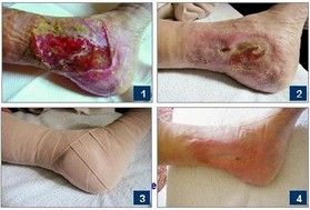 tratamentul cu piciorul varicos cauzeaza aspectul