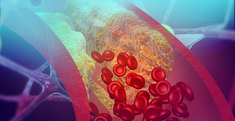 Vasculita necrozanta: afectiune care poate afecta orice vas de sange