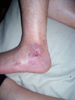 înfaurarea piciorului de lut din varico)