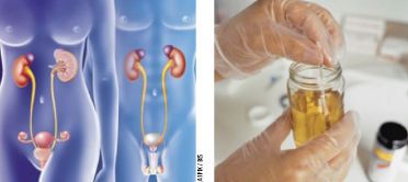 Ce este vezica urinară hiperactivă?