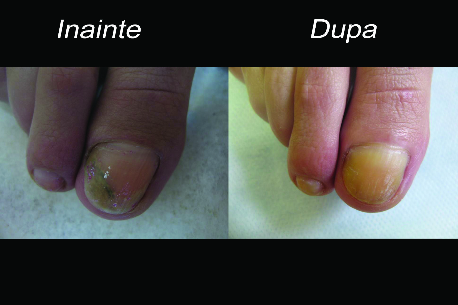 clearance tratament ciuperca unghiilor Cum distruge o ciupercă o unghie?