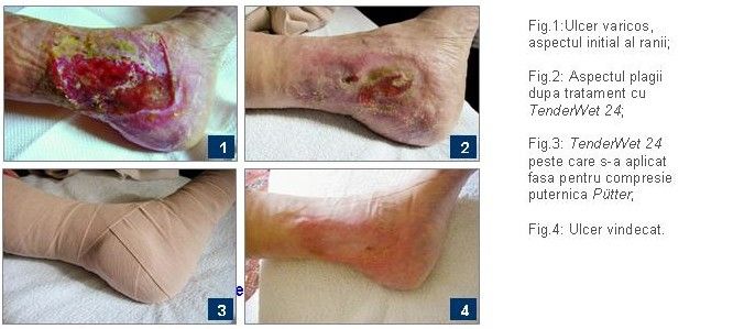 tratamentul ranilor pe picioare în varicoza