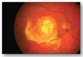Degenerescența maculară legată de vârstă - Vitreum - Centru medical oftalmologic