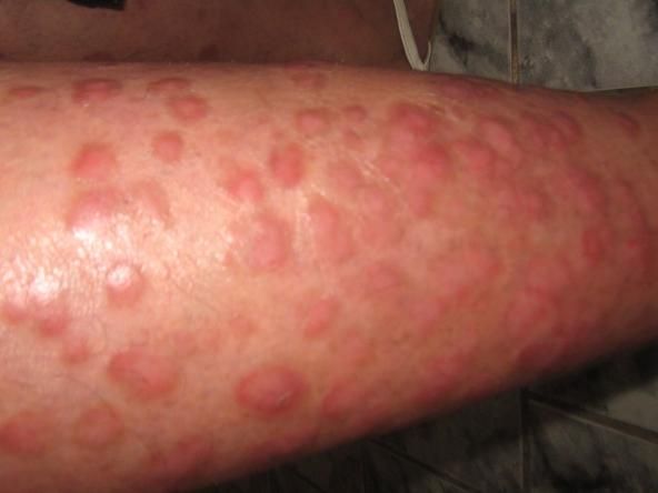 Cancer de piele inainte de tratament si dupa 3 luni de tratament