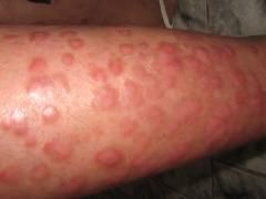 Cancer de piele inainte de tratament si dupa 3 luni de tratament