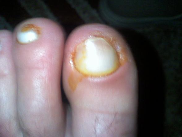 deget mare  de la piciorul stang