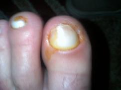 deget mare  de la piciorul stang