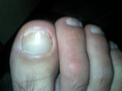 deget mare picior drept