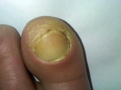 deget mare inflamat de la piciorul stang