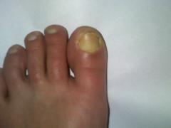 deget mare inflamat picior stang